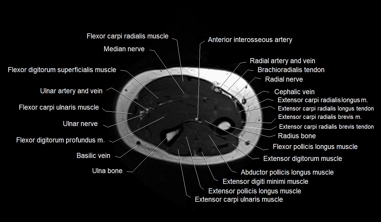 MRI 3T forearm axial cross sectional anatomy image 30.webp